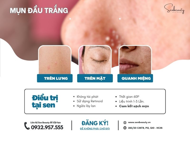 Trị các loại mụn nhọt trứng cá có cam kết